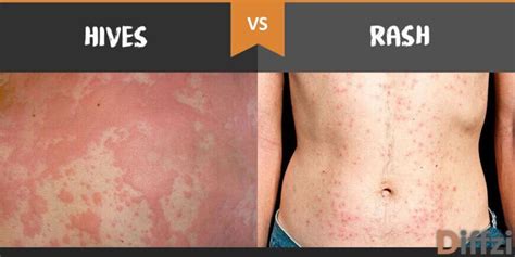 Hives Vs Rash Hives Urticaria Causes Treatment And Symptoms Spots