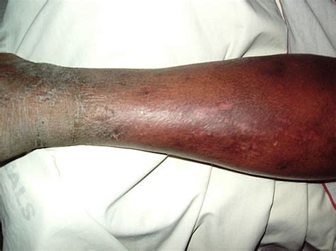 Cellulitis Leg Early