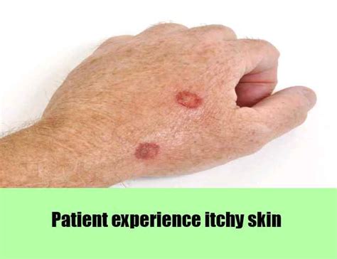 Liver Disease Itchy Skin Rash