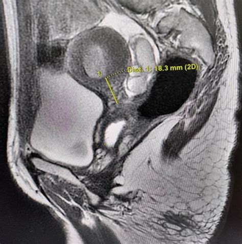 T2 Weighted Magnetic Resonance Imaging Showing Hematometra With An