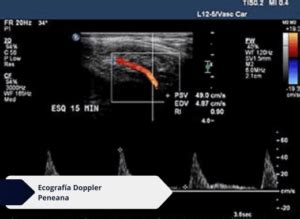 Ecografía Doppler Peneana Ecodoppler Vascular en Bogotá