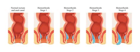 Hemorrhoid Surgery During Colonoscopy At Jon Rittenhouse Blog