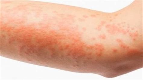 Aids Skin Rash