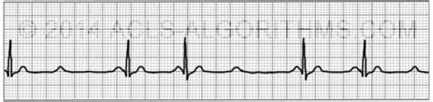 Second Degree Heart Block- Type 2