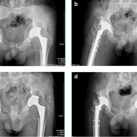 A Pre Operative Anteroposterior Ap Radiographs Taken In June 2011 Download Scientific