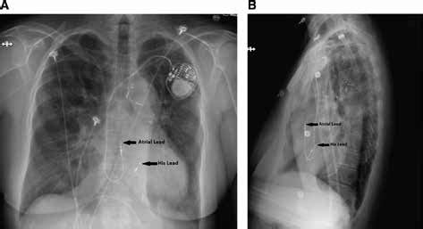 A Anteroposterior Chest Radiograph Showing Lead Placement In A