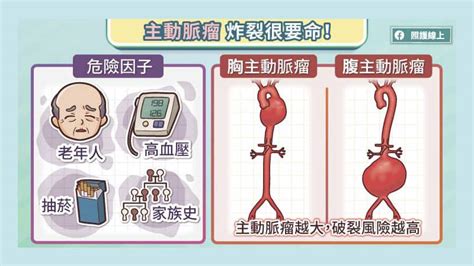 致命的主動脈剝離與主動脈瘤，微創主動脈支架手術治療解析 健康醫療網