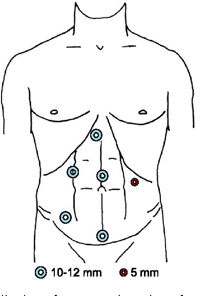 Figure 1 From Laparoscopic Combined Colorectal And Liver Resections For