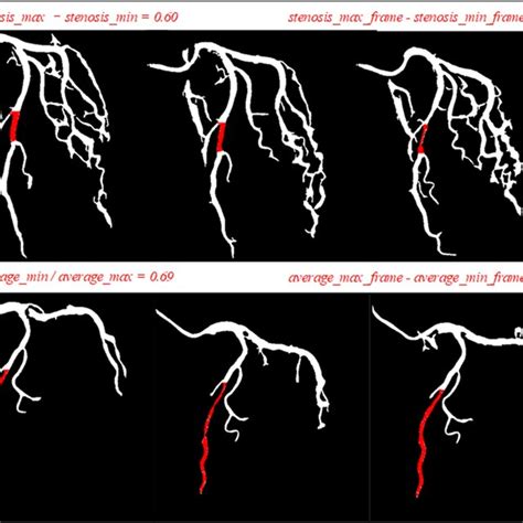 (PDF) A framework of myocardial bridge detection with x-ray angiography ...