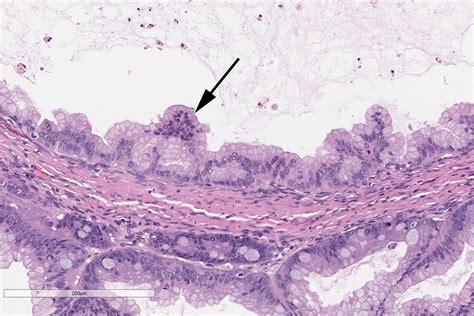 Mucinous Neoplasms Of The Ovary Radiologic Pathologic Correlation