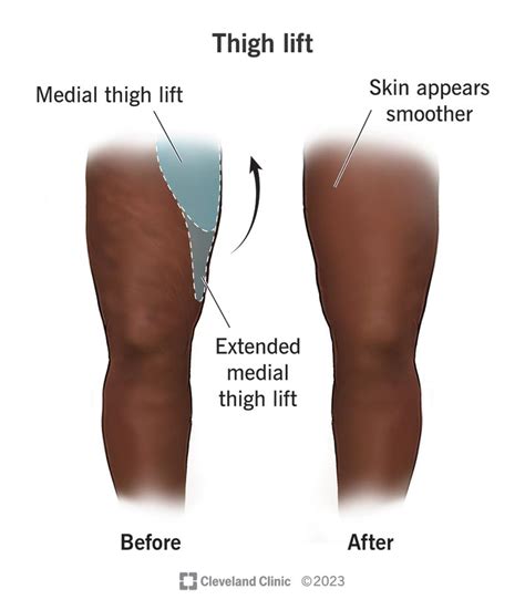 Loose Skin On Inner Thighs After Weight Loss Sale