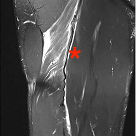 MRI of grade 3c (large tear involving 50–100% of muscle cross-sectional ...