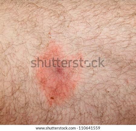 Borrelia Infection, Lyme Disease Danger. Stock Photo 110641559 ...