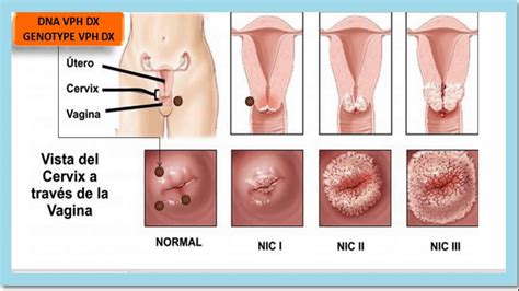 Que Es Papiloma Humano Vph En Hombres Y Mujeres Sintomas Tipos