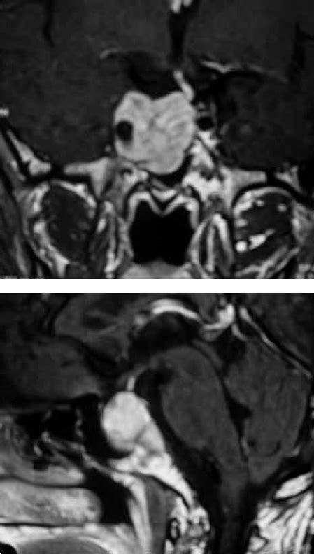 Magnetic Resonance Imaging Of The Sellar Region Case 2 Magnetic