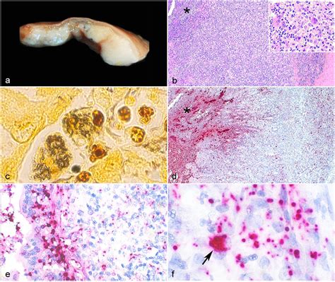 Adherent Invasive Escherichia Coli Associated With Granulomatous Colitis And Extraintestinal