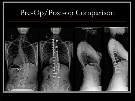 Case Presentation 56 Adult Idiopathic Scoliosis