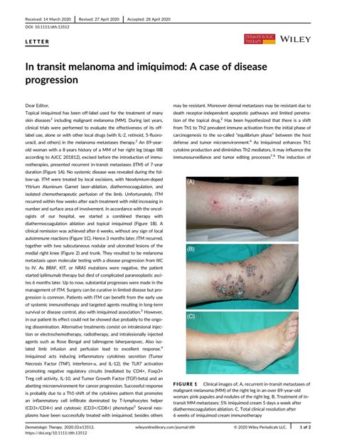 In Transit Melanoma And Imiquimod A Case Of Disease Progression