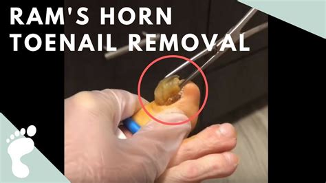 Toenail Removal Ingrown Toe Nail Ram Horns Podiatry Couple Weeks