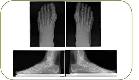 Caso De Estudio Hallux Valgus Bilateral Jordi Mayral