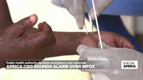 Sering Dianggap Sama Ternyata Ini Perbedaan Mpox Dengan Penyakit Cacar