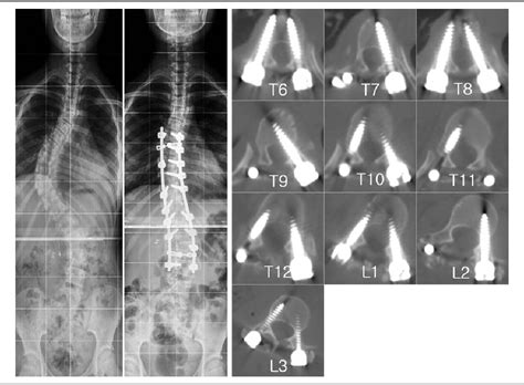 Figure 1 From Accuracy Of Thoracic Pedicle Screw Placement Using