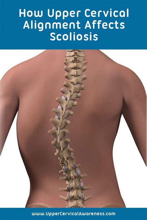 Effects Of Upper Cervical Alignment In Scoliosis Upper Cervical Awareness