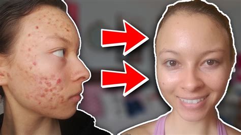 How Did She Clear Her Acne So Quick 10 Wk Transformation Youtube