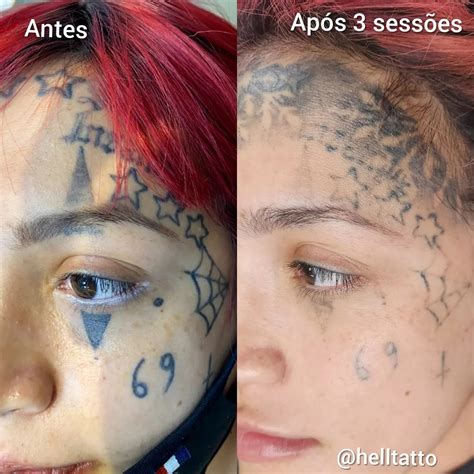 Antes e Depois de Remoção de Tatuagem HellTattoo