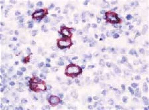 T Cell Histiocyte Rich Large B Cell Lymphoma With Cd20 Positive Tumor Download Scientific