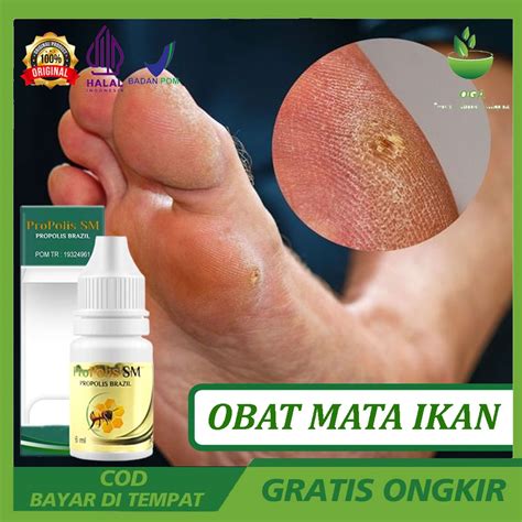 Jual Obat Perontok Mata Ikan Obat Mata Ikan Pada Telapak Kaki Tangan