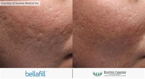 Vancouver Bellafill Long Lasting Filler Surrey White Rock Langley