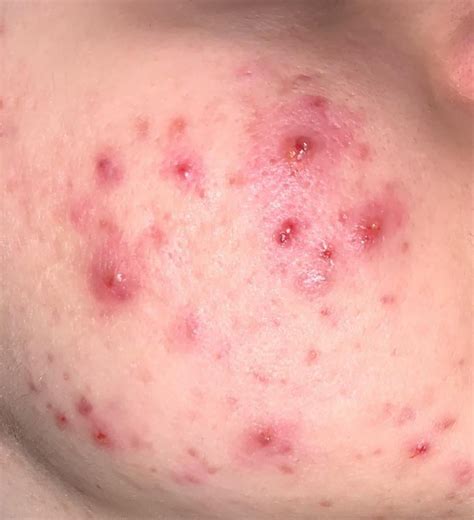 Is This Staph Acne Look In The Comments R Staphacne