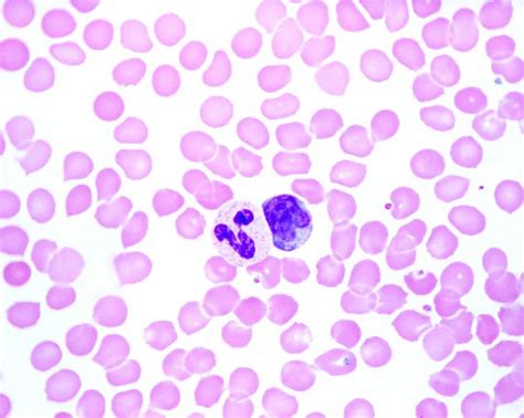 Human Blood Smear Leukocytosis Acute Infection Neutrophil Leukocyte