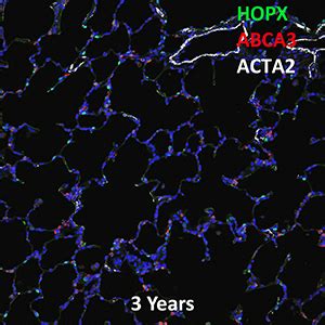 Year Human Lung Hopx Abca And Acta Confocal Imaging