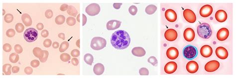 Laboratory Diagnosis Of Megaloblastic Anemia Mba