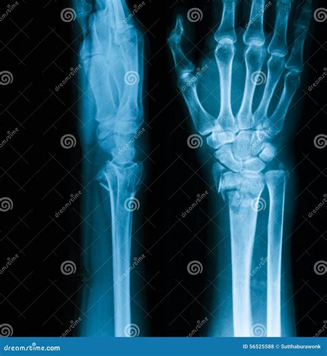 Wrist Joint X Ray