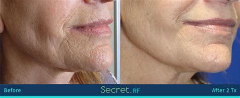 Secret Rf Micro Needling Genuineu Md