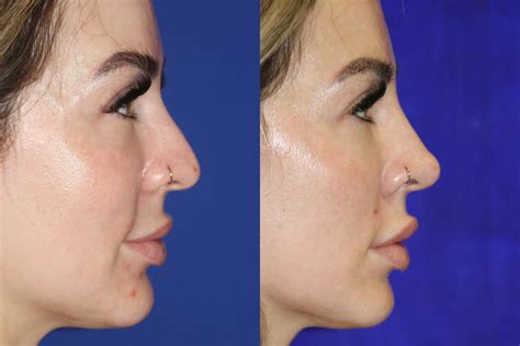 Liquid Rhinoplasty For Non Surgical Nose Jobs In Santa Rosa