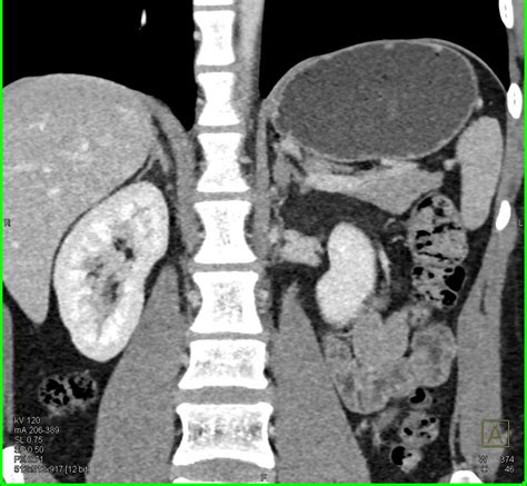 Bilateral Adrenal Adenomas Adrenal Case Studies Ctisus Ct Scanning