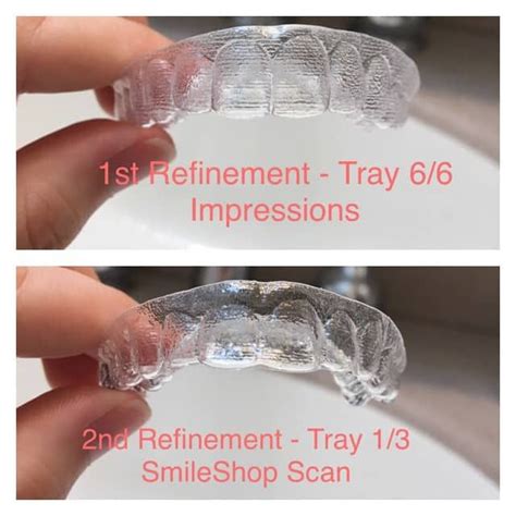 Smile Direct Club Invisible Aligner Review | Smile direct, Perfect ...