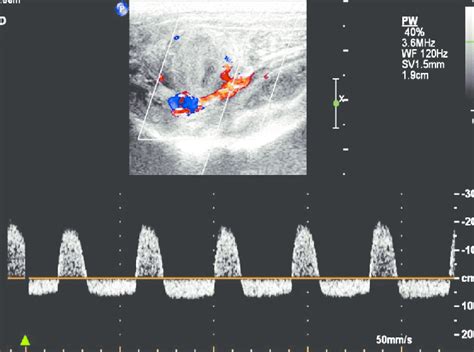 Spectral Doppler Ultrasound Definition Definition Hjo