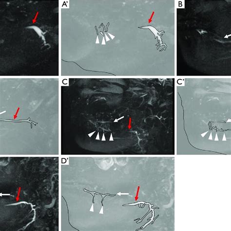 Drainage Patterns Of The Bartholin And Or Rivinus Ducts In Subjects