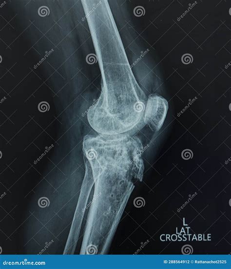 X Ray Left Knee Lateral Showing Kneecap Fracture And Post Operation