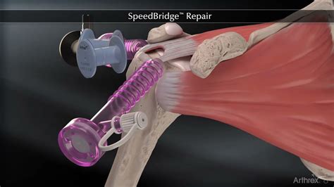 R Paration De La Coiffe Des Rotateurs Sous Arthroscopie Youtube