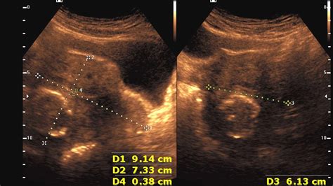 Ultrasound Cases 84 Of 2000 Fibroid With Egg Shell Calcification Youtube