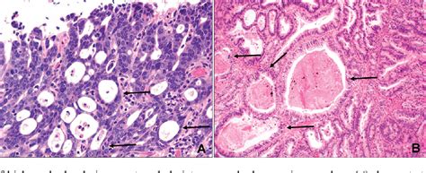 Figure 2 From Poor Interobserver Agreement In The Distinction Of High