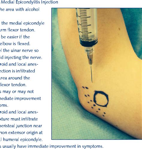 Figure 4 From A Review Of Anatomical Placement Of Corticosteroid