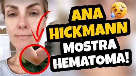 Veja Agora Ela Apareceu No Programa Mostrando Hematoma Ana Hickmann