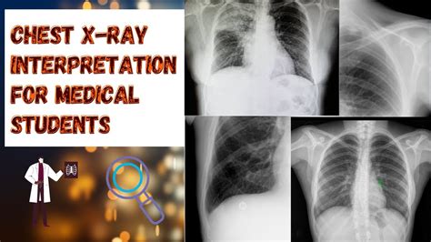 Chest X-Ray Interpretation for Medical Students | ABCDE approach - YouTube